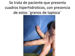 Se trata de paciente que presenta
cuadros hiperhidroticos, con presencia
de estos ¨granos de tapioca¨
 