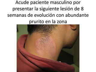 Acude paciente masculino por
presentar la siguiente lesión de 8
semanas de evolución con abundante
prurito en la zona
 
