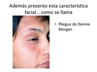 Además presento esta característica
facial… como se llama
• Pliegue de Dennie
Morgan
 