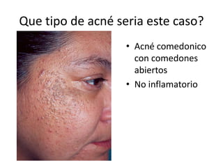 Que tipo de acné seria este caso?
• Acné comedonico
con comedones
abiertos
• No inflamatorio
 