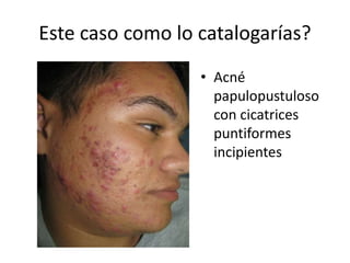 Este caso como lo catalogarías?
• Acné
papulopustuloso
con cicatrices
puntiformes
incipientes
 