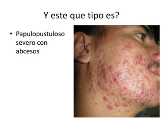 Y este que tipo es?
• Papulopustuloso
severo con
abcesos
 