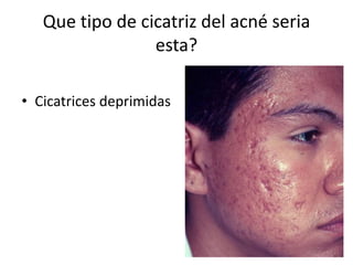 Que tipo de cicatriz del acné seria
esta?
• Cicatrices deprimidas
 