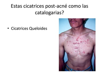 Estas cicatrices post-acné como las
catalogarias?
• Cicatrices Queloides
 