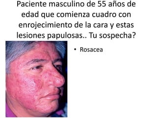 Paciente masculino de 55 años de
edad que comienza cuadro con
enrojecimiento de la cara y estas
lesiones papulosas.. Tu sospecha?
• Rosacea
 