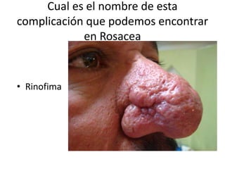 Cual es el nombre de esta
complicación que podemos encontrar
en Rosacea
• Rinofima
 