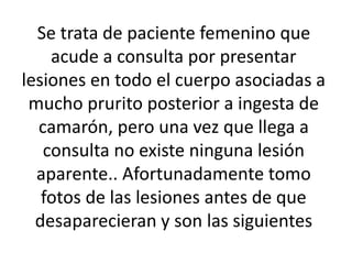 Se trata de paciente femenino que
acude a consulta por presentar
lesiones en todo el cuerpo asociadas a
mucho prurito posterior a ingesta de
camarón, pero una vez que llega a
consulta no existe ninguna lesión
aparente.. Afortunadamente tomo
fotos de las lesiones antes de que
desaparecieran y son las siguientes
 