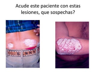 Acude este paciente con estas
lesiones, que sospechas?
 
