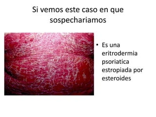 Si vemos este caso en que
sospechariamos
• Es una
eritrodermia
psoriatica
estropiada por
esteroides
 