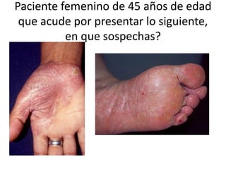 Paciente femenino de 45 años de edad
que acude por presentar lo siguiente,
en que sospechas?
 