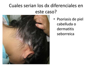 Cuales serian los dx diferenciales en
este caso?
• Psoriasis de piel
cabelluda o
dermatitis
seborreica
 