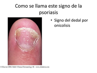 Como se llama este signo de la
psoriasis
• Signo del dedal por
onicolisis
 