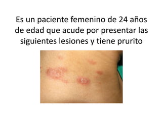 Es un paciente femenino de 24 años
de edad que acude por presentar las
siguientes lesiones y tiene prurito
 