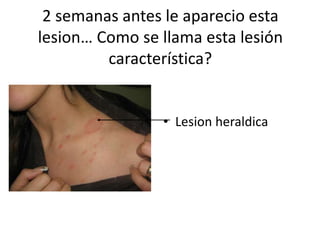 2 semanas antes le aparecio esta
lesion… Como se llama esta lesión
característica?
• Lesion heraldica
 