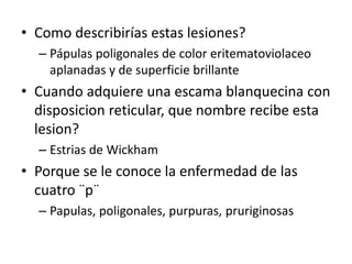 • Como describirías estas lesiones?
– Pápulas poligonales de color eritematoviolaceo
aplanadas y de superficie brillante
• Cuando adquiere una escama blanquecina con
disposicion reticular, que nombre recibe esta
lesion?
– Estrias de Wickham
• Porque se le conoce la enfermedad de las
cuatro ¨p¨
– Papulas, poligonales, purpuras, pruriginosas
 