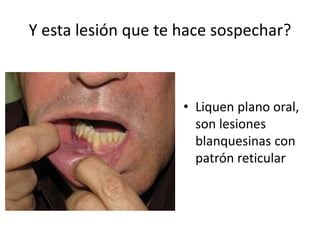 Y esta lesión que te hace sospechar?
• Liquen plano oral,
son lesiones
blanquesinas con
patrón reticular
 