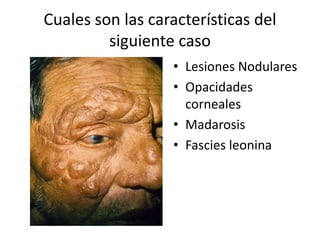 Cuales son las características del
siguiente caso
• Lesiones Nodulares
• Opacidades
corneales
• Madarosis
• Fascies leonina
 