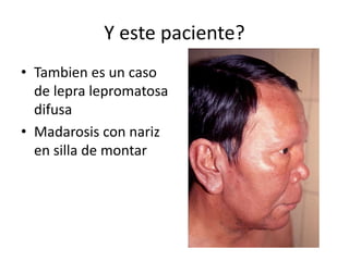 Y este paciente?
• Tambien es un caso
de lepra lepromatosa
difusa
• Madarosis con nariz
en silla de montar
 