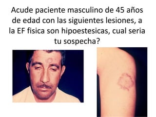 Acude paciente masculino de 45 años
de edad con las siguientes lesiones, a
la EF fisica son hipoestesicas, cual seria
tu sospecha?
 