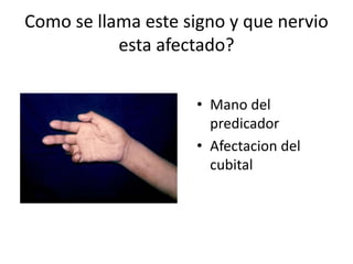 Como se llama este signo y que nervio
esta afectado?
• Mano del
predicador
• Afectacion del
cubital
 