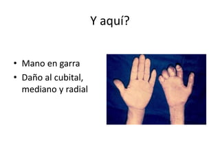 Y aquí?
• Mano en garra
• Daño al cubital,
mediano y radial
 