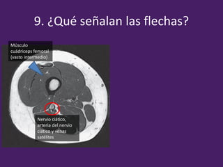 9. ¿Qué señalan las flechas?
Músculo
cuádriceps femoral
(vasto intermedio)
Nervio ciático,
arteria del nervio
ciático y venas
satélites
 