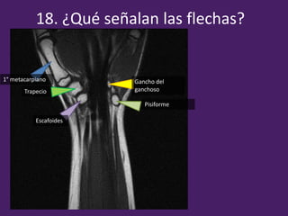 18. ¿Qué señalan las flechas?
Escafoides
Trapecio
1° metacarpiano
Pisiforme
Gancho del
ganchoso
 