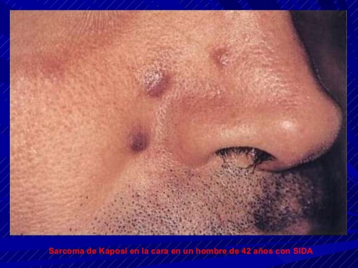 MANIFESTACIONES ORALES DE LA INFECCION POR VIH/SIDA