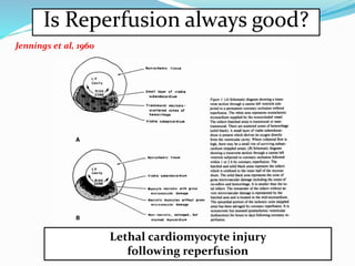 myocardial Reperfusion injury | PPTX