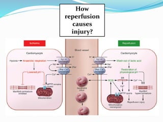 myocardial Reperfusion injury | PPTX