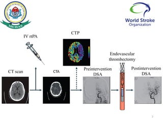 Reperfusion therapy for Acute ischemic stroke by Dr. Basil Tumaini | PPTX
