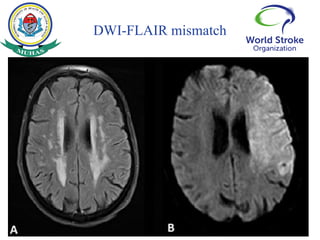 Reperfusion therapy for Acute ischemic stroke by Dr. Basil Tumaini | PPTX