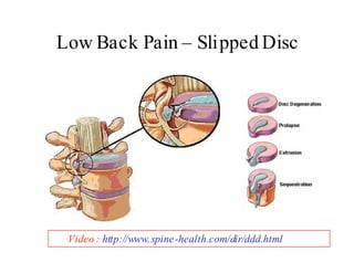 Repetitive Strain Injury Low Res