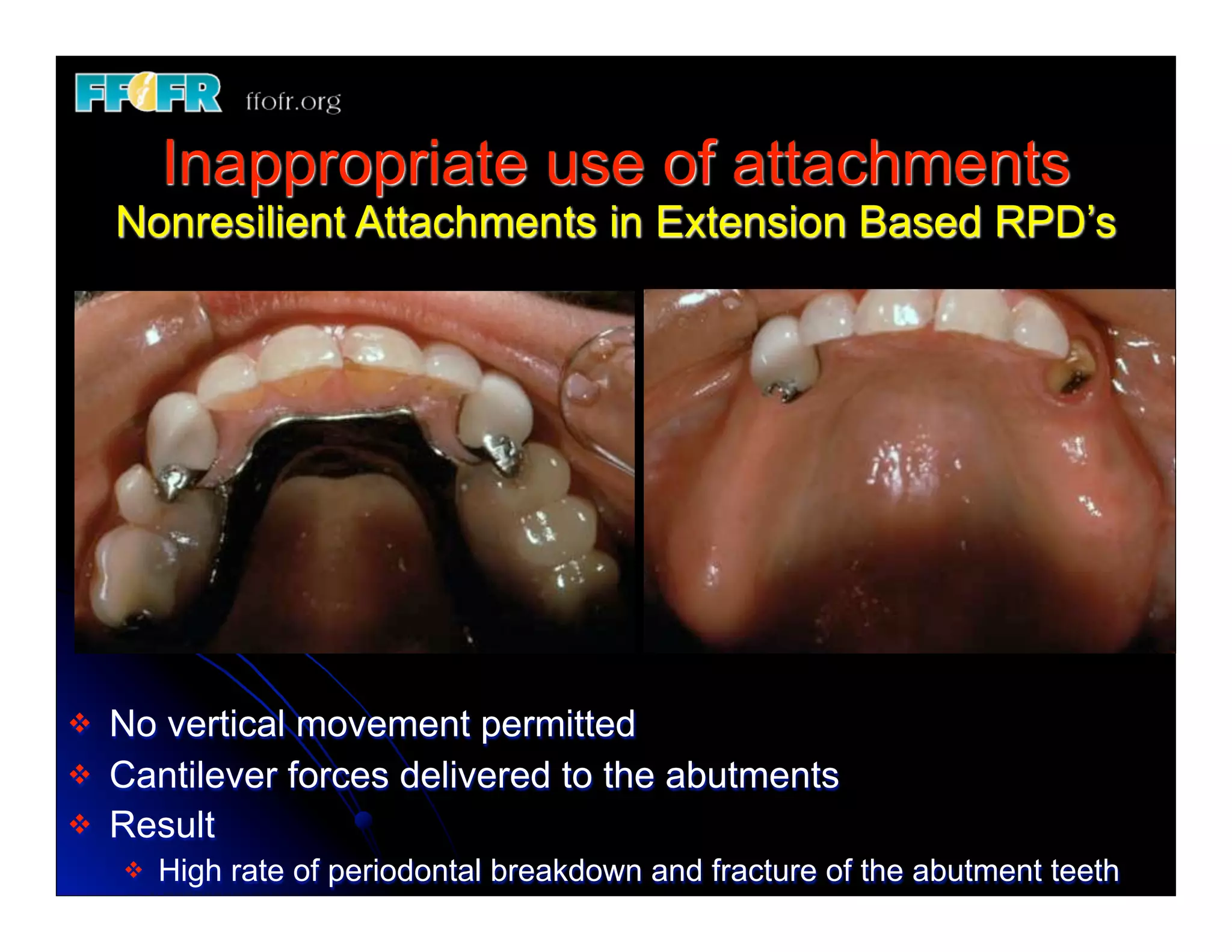Internal Attachment In Rpd (Replace) 11.esthetics, rotational path, attachments | PDF
