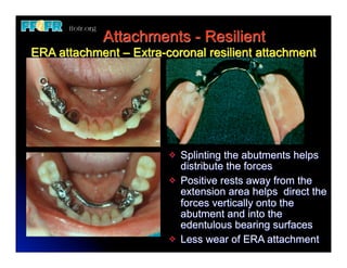 Attachments - Resilient
ERA attachment – Extra-coronal resilient attachment




                        v   Splinting the abutments helps
                             distribute the forces
                        v   Positive rests away from the
                             extension area helps direct the
                             forces vertically onto the
                             abutment and into the
                             edentulous bearing surfaces
                        v   Less wear of ERA attachment
 