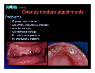 Overlay denture attachments
Problems
  v   Copings become loose
  v   Attachment wear, loss & breakage
  v   Alveolar resorption
  v   Overdenture breakage
  v   Pt. maintenance problems
  v   Pt. oral hygiene problems
 