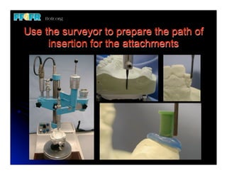 Use the surveyor to prepare the path of
     insertion for the attachments
 