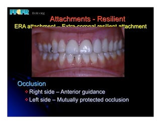 Attachments - Resilient
ERA attachment – Extra-coronal resilient attachment




 Occlusion
   v Right  side – Anterior guidance
   v Left side – Mutually protected occlusion
 