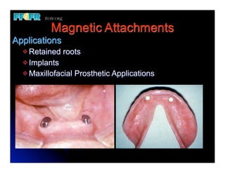 Magnetic Attachments
Applications
  v Retained   roots
  v Implants
  v Maxillofacial   Prosthetic Applications
 
