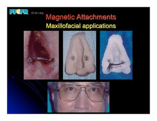 Magnetic Attachments
Maxillofacial applications
 