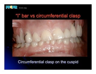 “I” bar vs circumferential clasp




 Circumferential clasp on the cuspid
 