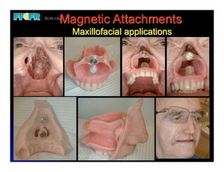 Magnetic Attachments
  Maxillofacial applications
 