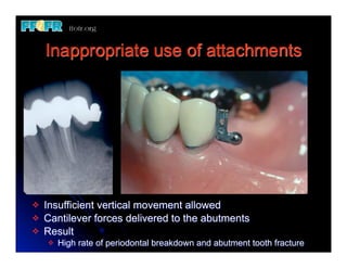 Inappropriate use of attachments




v   Insufficient vertical movement allowed
v   Cantilever forces delivered to the abutments
v   Result
     v   High rate of periodontal breakdown and abutment tooth fracture
 
