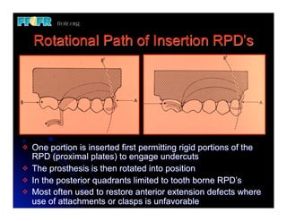 Rotational Path of Insertion RPD’s




v   One portion is inserted first permitting rigid portions of the
     RPD (proximal plates) to engage undercuts
v   The prosthesis is then rotated into position
v   In the posterior quadrants limited to tooth borne RPD’s
v   Most often used to restore anterior extension defects where
     use of attachments or clasps is unfavorable
 
