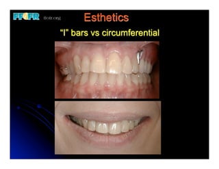 Esthetics
“I” bars vs circumferential
 