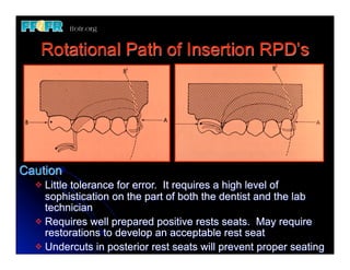 Rotational Path of Insertion RPD’s




Caution
  v Little tolerance for error. It requires a high level of
     sophistication on the part of both the dentist and the lab
     technician
  v Requires well prepared positive rests seats. May require
     restorations to develop an acceptable rest seat
  v Undercuts in posterior rest seats will prevent proper seating
 
