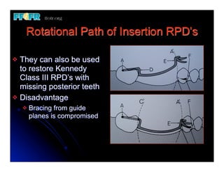 Rotational Path of Insertion RPD’s

v They can also be used
   to restore Kennedy
   Class III RPD’s with
   missing posterior teeth
v Disadvantage
     v   Bracing from guide
          planes is compromised
 