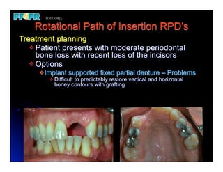 Rotational Path of Insertion RPD’s
Treatment planning
   v Patient presents with moderate periodontal
      bone loss with recent loss of the incisors
   v Options
     v Implant    supported fixed partial denture – Problems
        v   Difficult to predictably restore vertical and horizontal
             boney contours with grafting
 