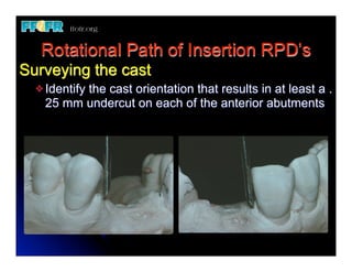 Rotational Path of Insertion RPD’s
Surveying the cast
  v Identify
          the cast orientation that results in at least a .
    25 mm undercut on each of the anterior abutments
 
