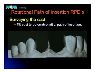 Rotational Rpd (Replace) 11.esthetics, rotational path, attachments | PDF
